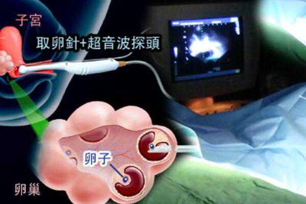 广州正规试管代生,广州的三代试管婴儿私立医院哪个最好？广州三代试管婴儿